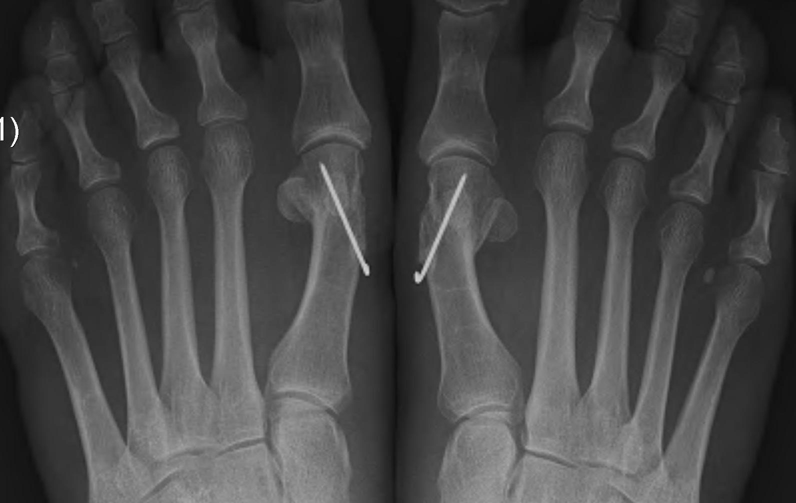 Hallux Valgus Chevron